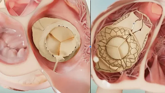 The first patients treated with new transcatheter tricuspid valve replacement system in October 2026.