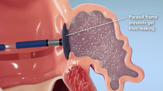 The Parasol Med Tech left atrial appendage closure (LAAO) system uses gel to completely fill and seal the LAA while a temporary shield prevents the gel from embolizing during delivery.