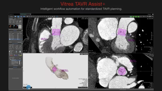 Canon Medical Informatics TAVR Assist+