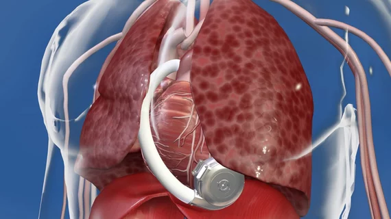 The U.S. Food and Drug Administration (FDA) is alerting healthcare providers to the possibility that patients who have a Medtronic Heartware Ventricular Assist Device (HVAD) System and present with pump thrombosis may have a welding defect in the internal pump, causing it to malfunction. Medtronic and the FDA issues the notice to providers April 28, 2022.