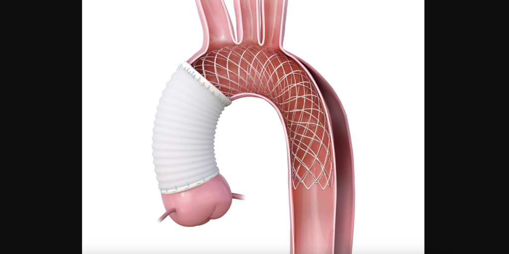 FDA approves surgical device for high-risk aortic procedures